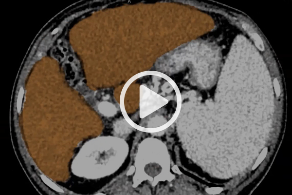 3D volumetric liver segmentation webinar image.