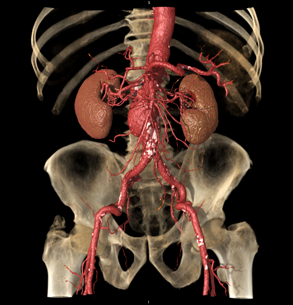 Advanced Clinical Workflows, Neuro, CT Aorta Analysis