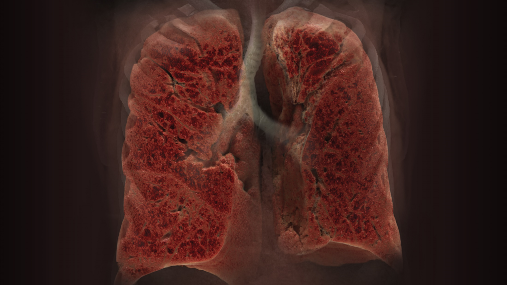 Advanced Clinical Workflows, Neuro, CT Larynx Airway Analysis image.