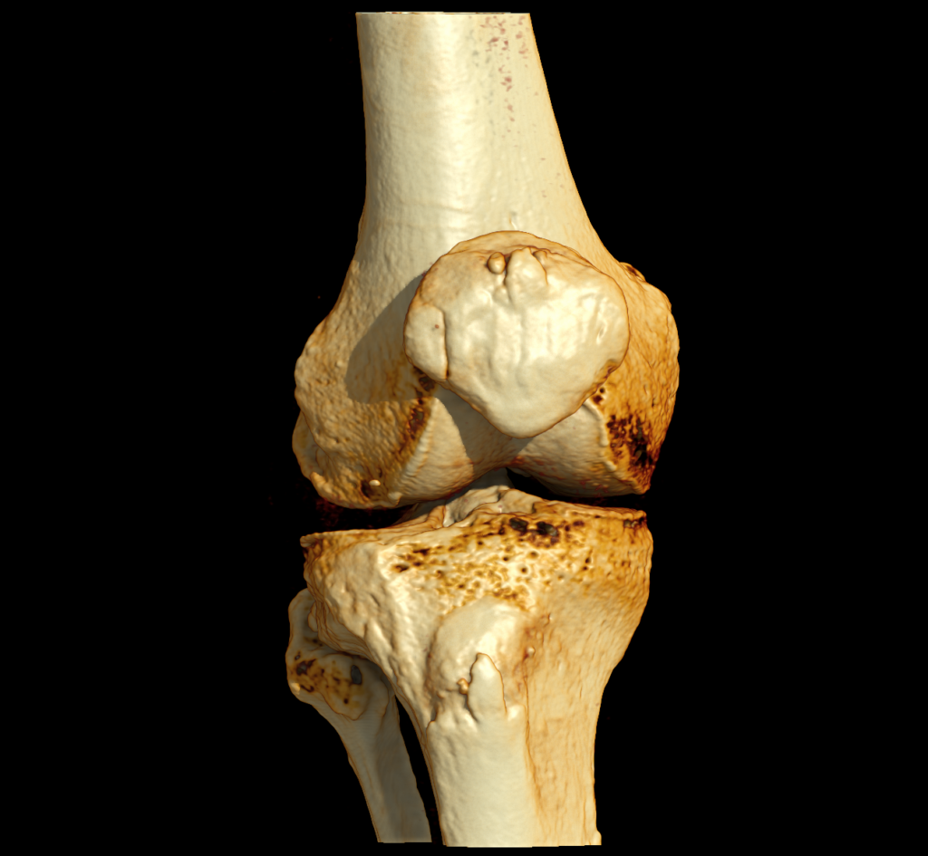 Advanced Clinical Workflows, CT Musculoskeletal image.