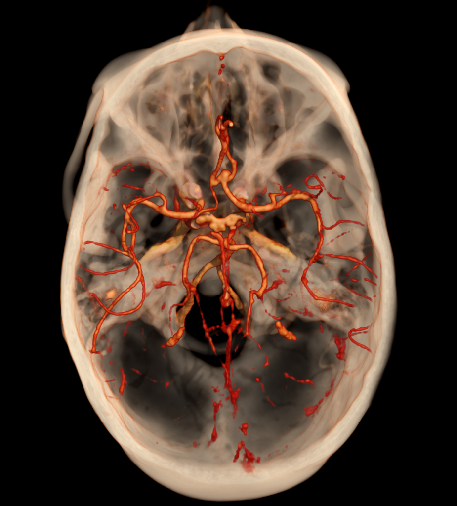 Advanced Clinical Workflows, Neuro, Circle of Willis.