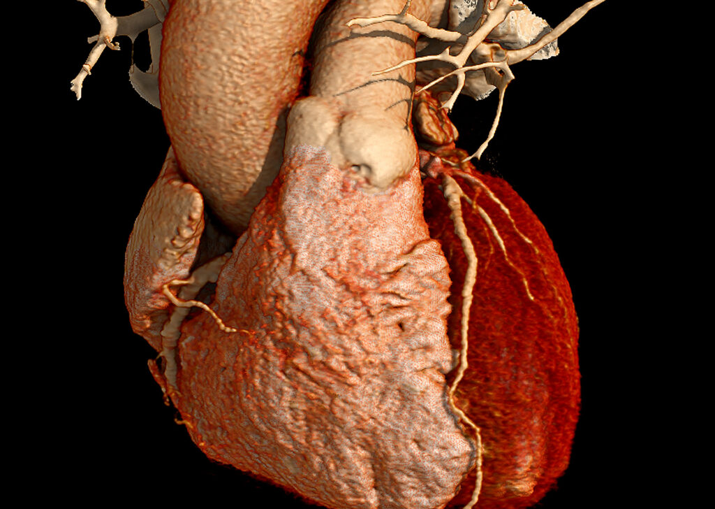 Advanced Clinical Workflows, Cardiology, CT Cardiac Analysis image.
