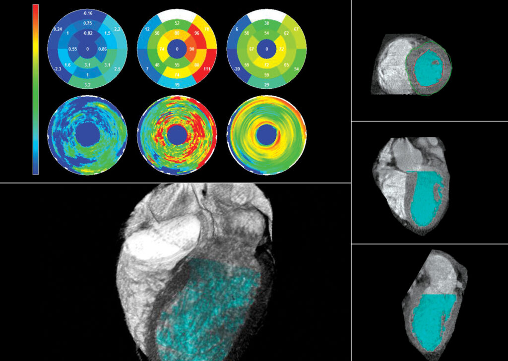 Advanced Clinical Workflows, Cardiology, CT Cardiac Functional Analysis image.