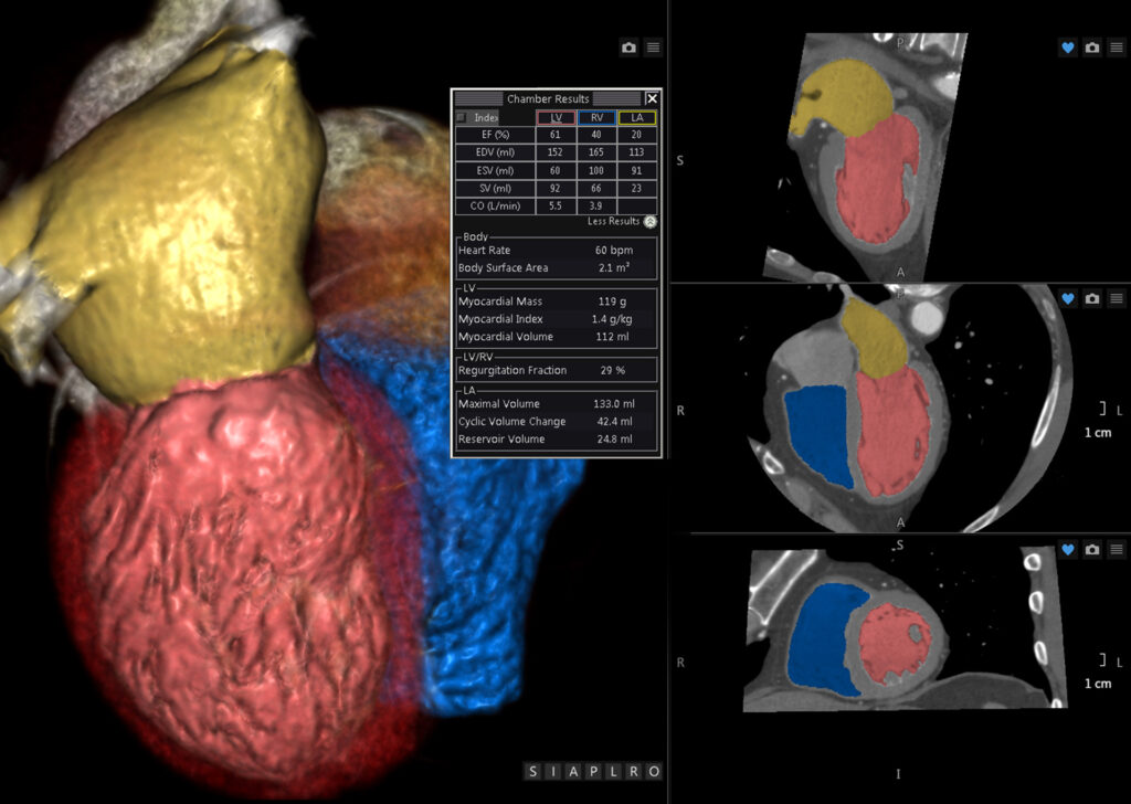 Advanced Clinical Workflows, Cardiology, CT Multichamber CFA image.