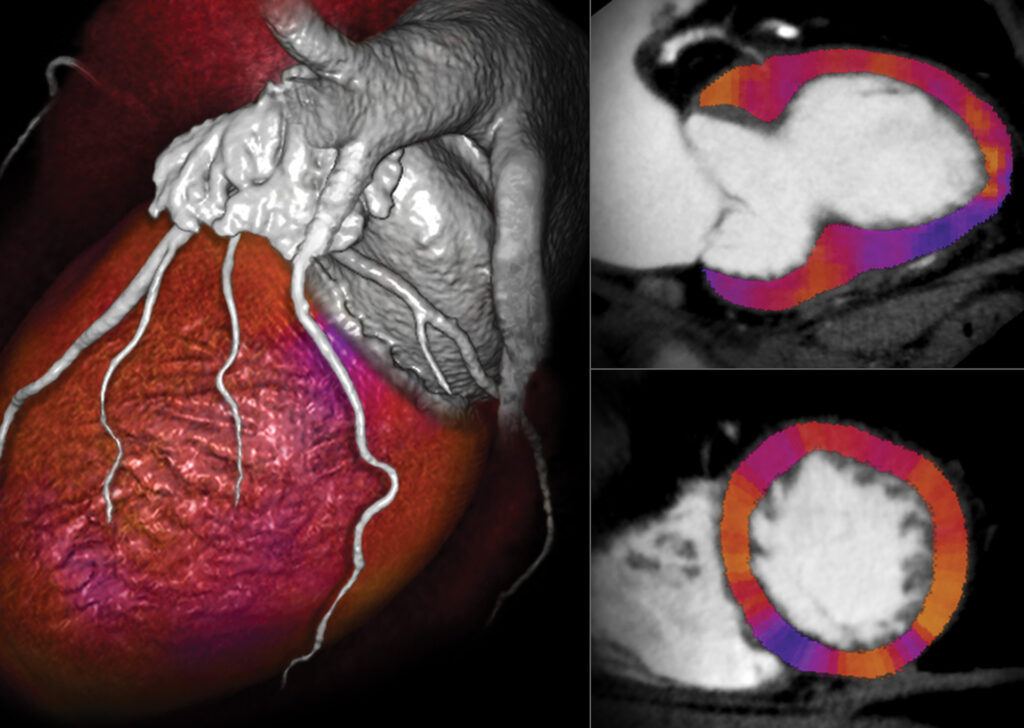 Advanced Clinical Workflows, Cardiology, CT Myocardial Perfusion image.