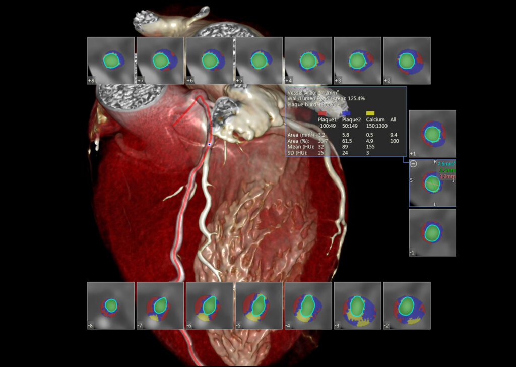 Advanced Clinical Workflows, Cardiology, CT SurePlaque image.