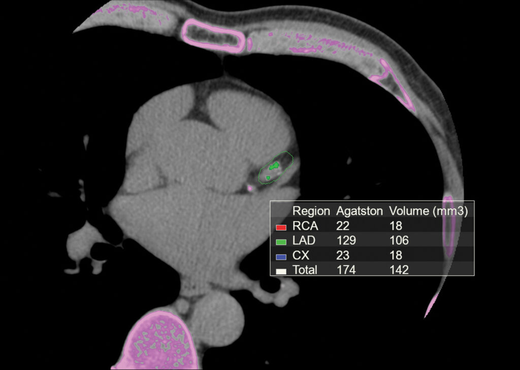 Advanced Clinical Workflows, Cardiology, CT VScore image.