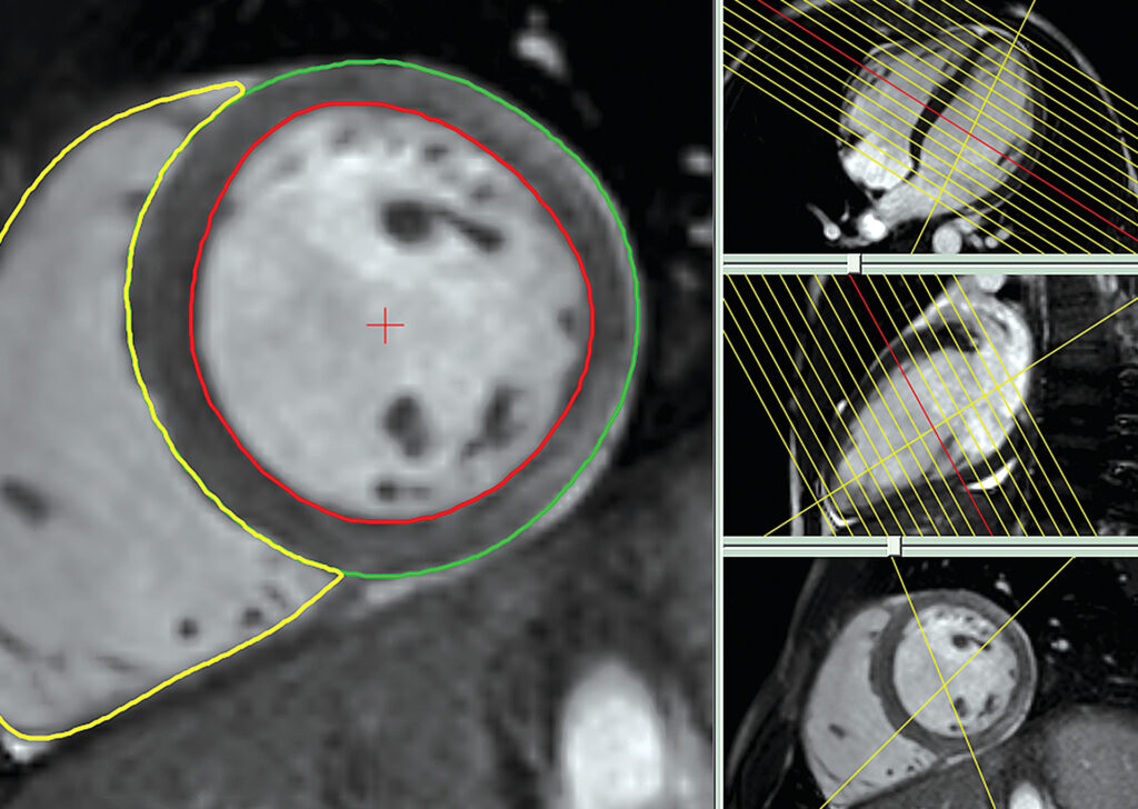 Advanced Clinical Workflows, Cardiology, Medis CVMR image.