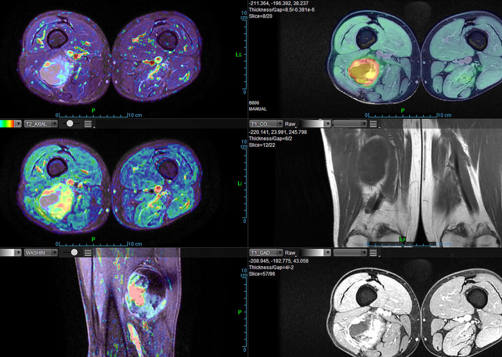 Advanced Clinical Workflows, Musculoskeletal, MSK Onco Inflammatory image.