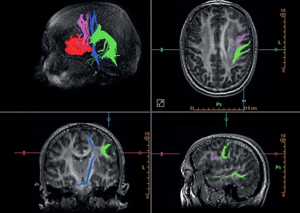 Advanced Clinical Workflows, Neurology, Functional MRI image.