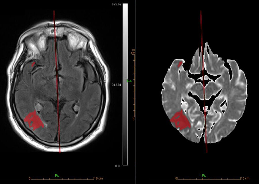 Advanced Clinical Workflows, Neurology, MR Basic Stroke image.
