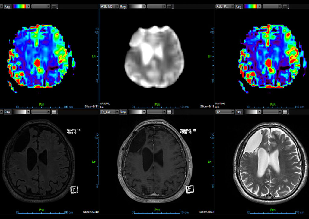 Advanced Clinical Workflows, Neurology, MR Neuro ASL image.