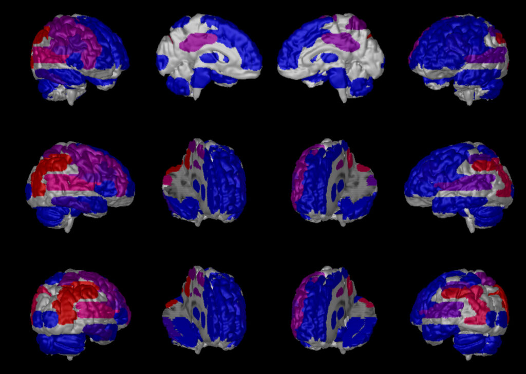 Advanced Clinical Workflows, Neurology, NeuroQ image.