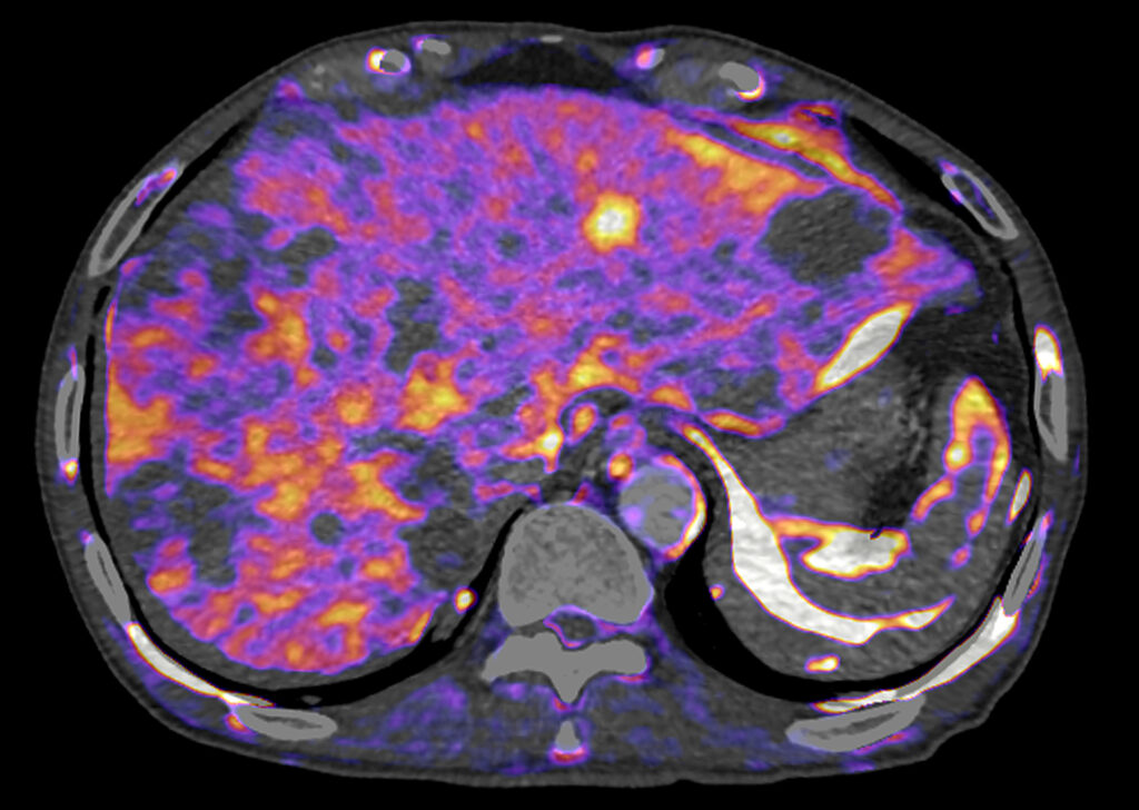 Advanced Clinical Workflows, Oncology, CT Body Perfusion image.