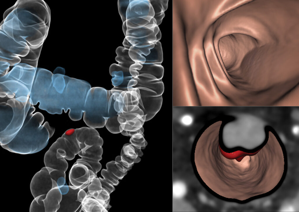 Advanced Clinical Workflows, Oncology, CT Colon Analysis image.