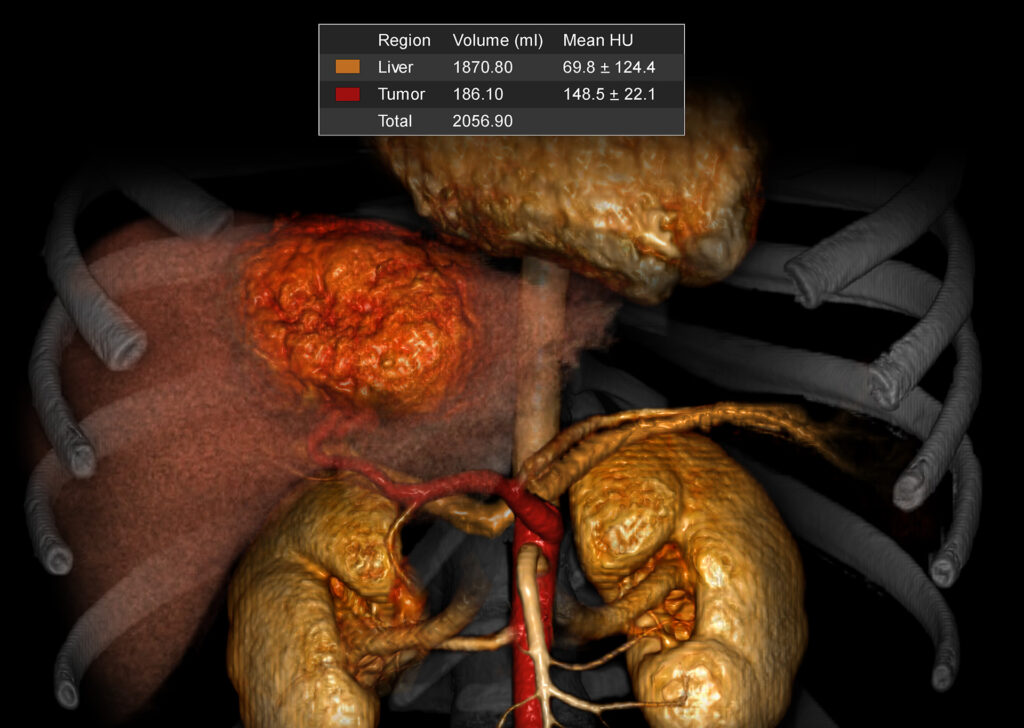 Advanced Clinical Workflows, Oncology, CT Liver Analysis image.