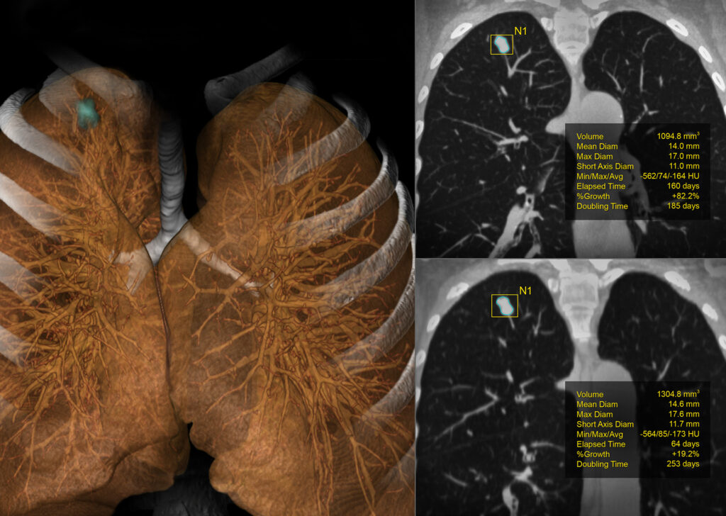 Advanced Clinical Workflows, Oncology, CT Lung Analysis image.