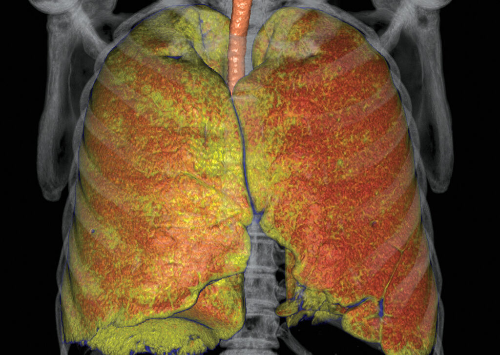 Advanced Clinical Workflows, Oncology, CT Lung Density Analysis image.
