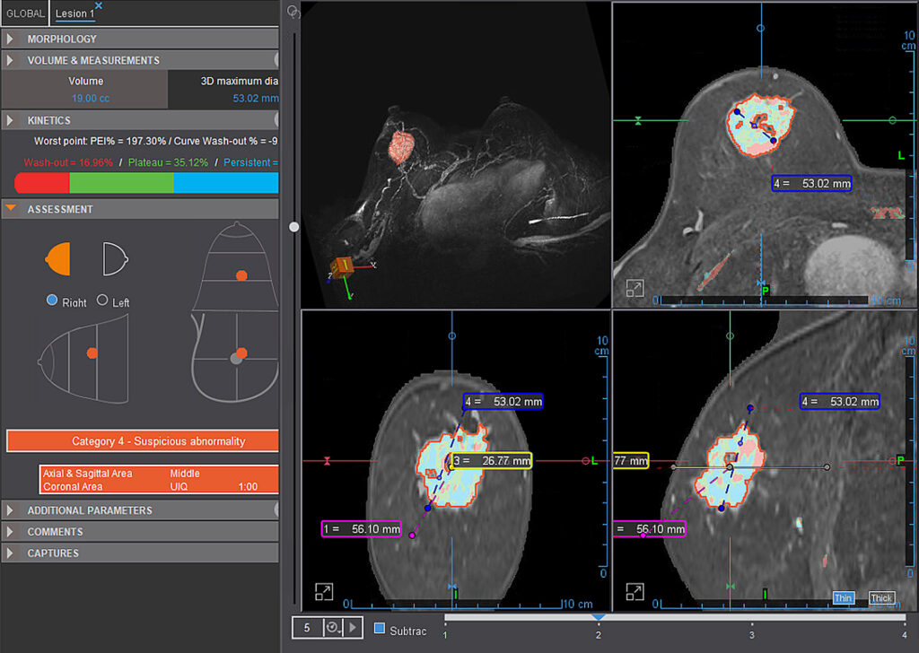 Advanced Clinical Workflows, Oncology, MR Breast Advanced image.