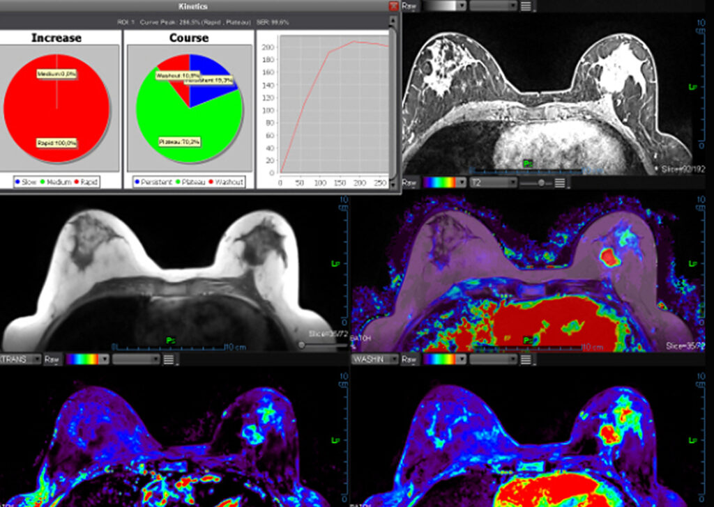 Advanced Clinical Workflows, Oncology, MR Breast Basic image.