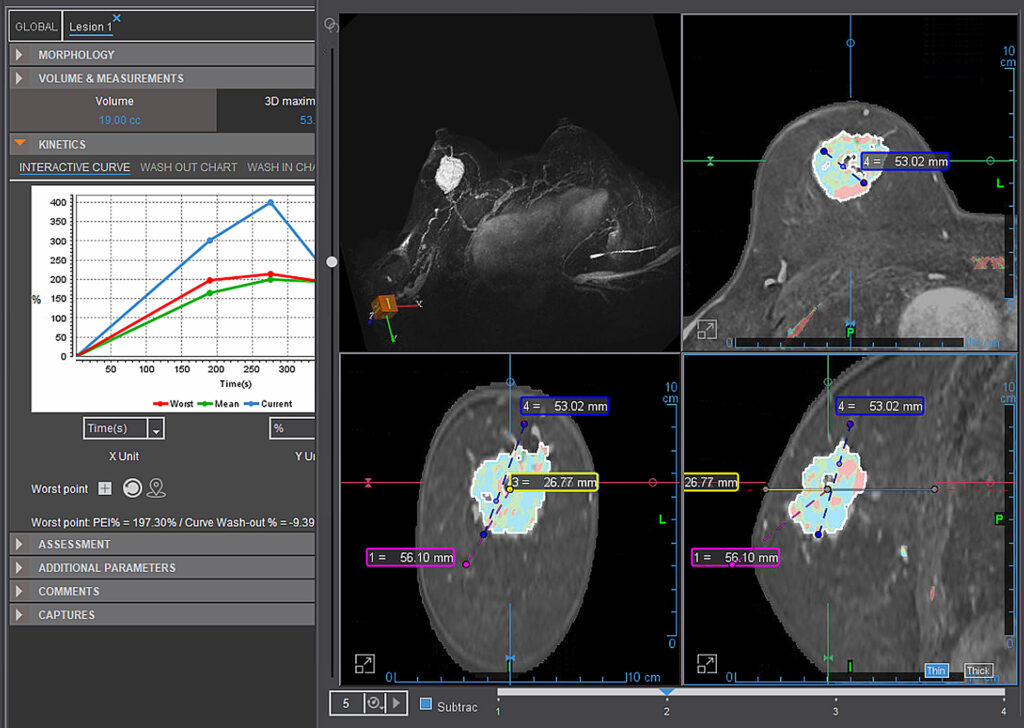 Advanced Clinical Workflows, Oncology, MR Breast Biopsy image.