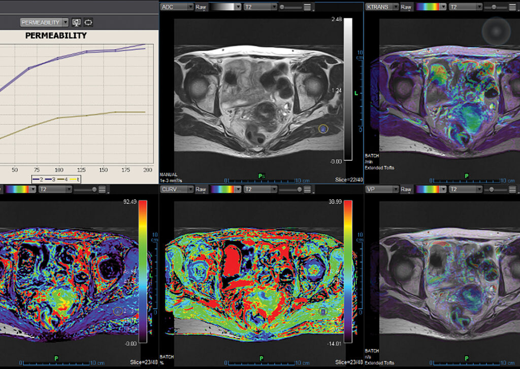 Advanced Clinical Workflows, Oncology, MR Female Pelvis image.