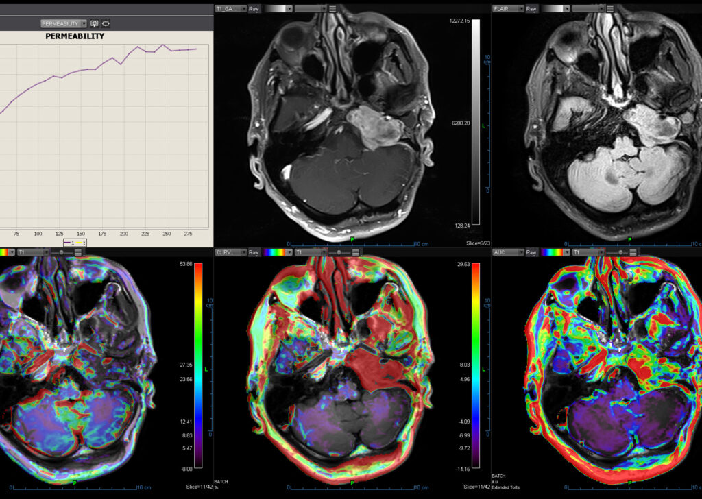 Advanced Clinical Workflows, Oncology, MR Head Neck image.