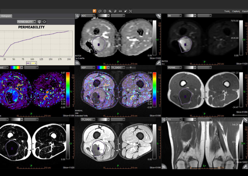 Advanced Clinical Workflows, Oncology, MR MSK image.