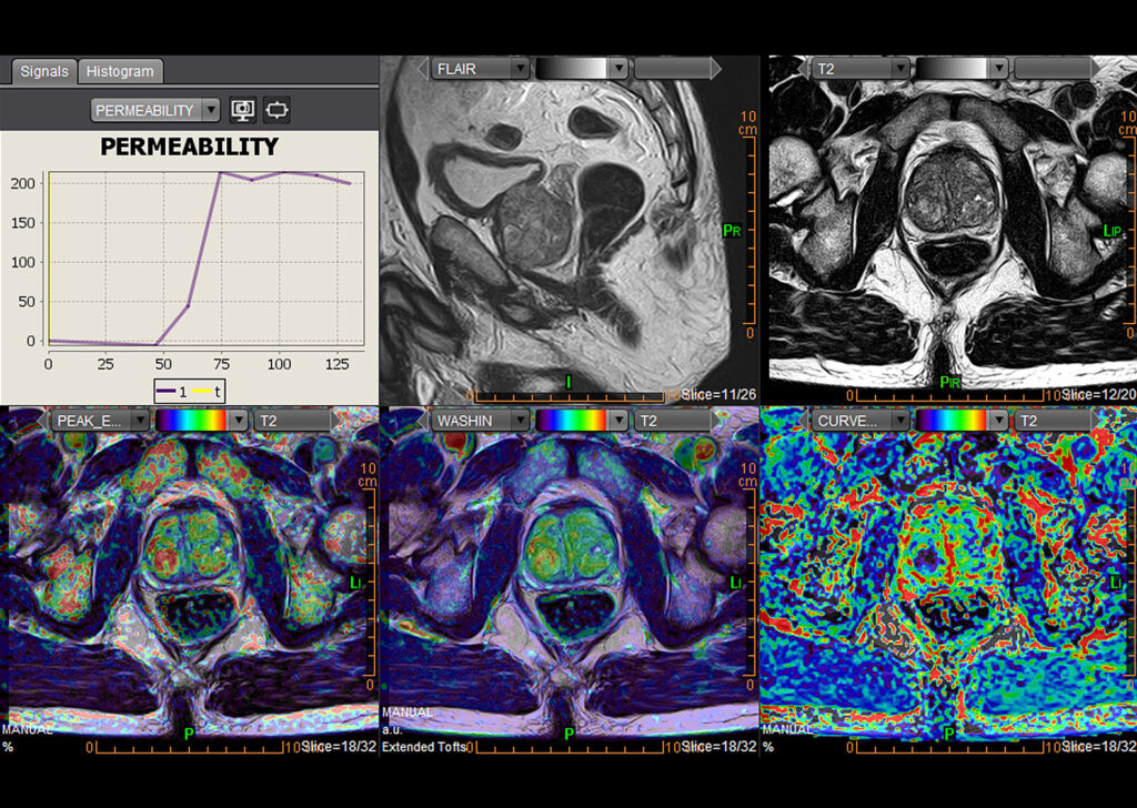 Advanced Clinical Workflows, Oncology, MR Prostate image.