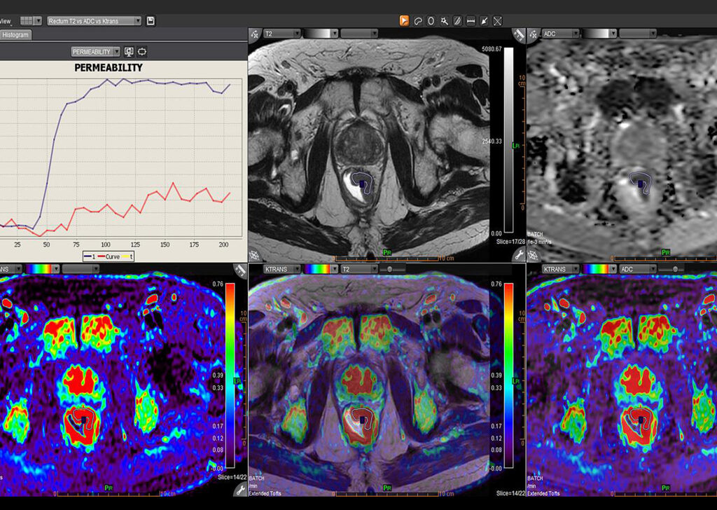 Advanced Clinical Workflows, Oncology, MR Rectum image.