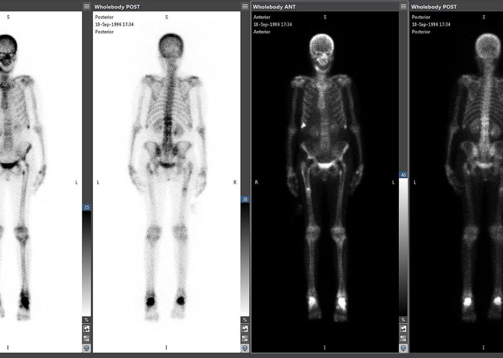 Advanced Clinical Workflows, Oncology, Mirada Nuclear Medicine image.