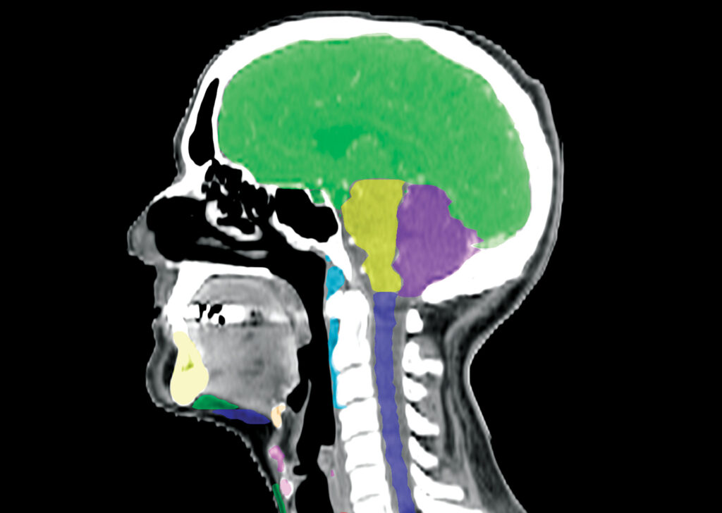 Advanced Clinical Workflows, Oncology, Mirada RTx image.