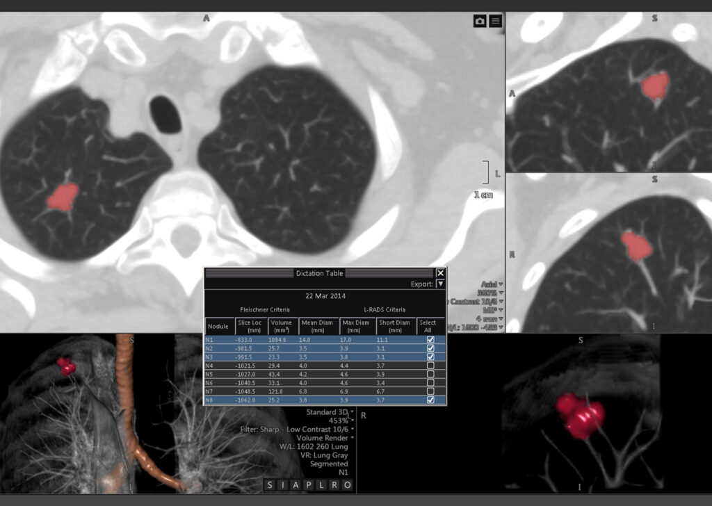 Advanced Clinical Workflows, Oncology, CT Lung CAD.