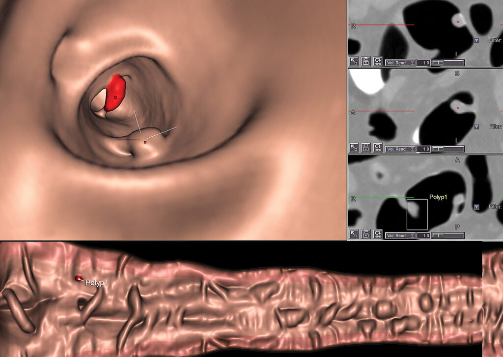 Advanced Clinical Workflows, Oncology, ICAD Veralook image.