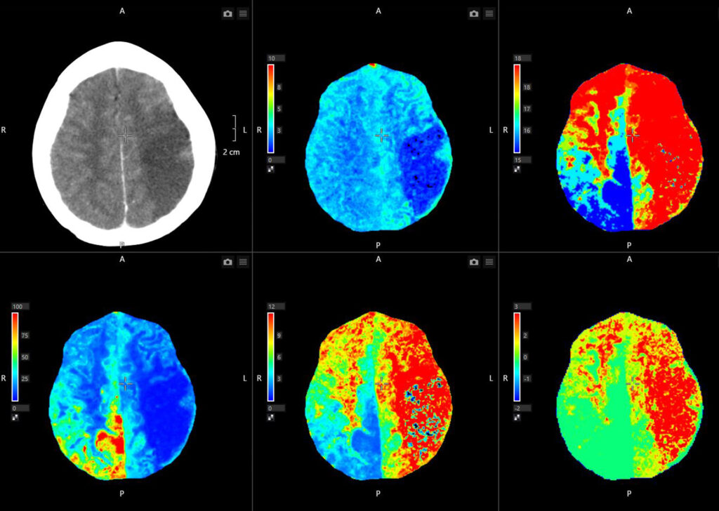 Advanced Clinical Workflows, Vascular CT Brain Perfusion 2D image.