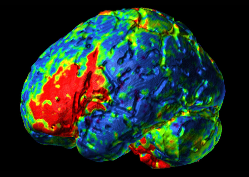 Advanced Clinical Workflows, Vascular CT Brain Perfuion 4D image.