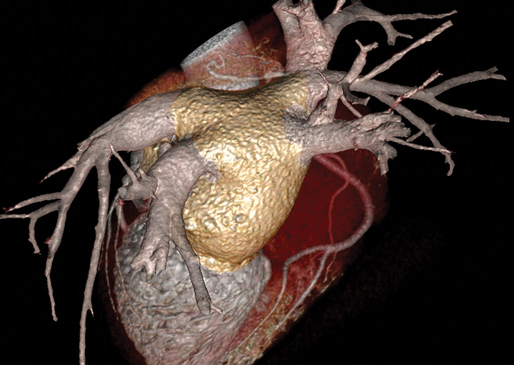 Advanced Clinical Workflows, Vascular CT EP Planning.