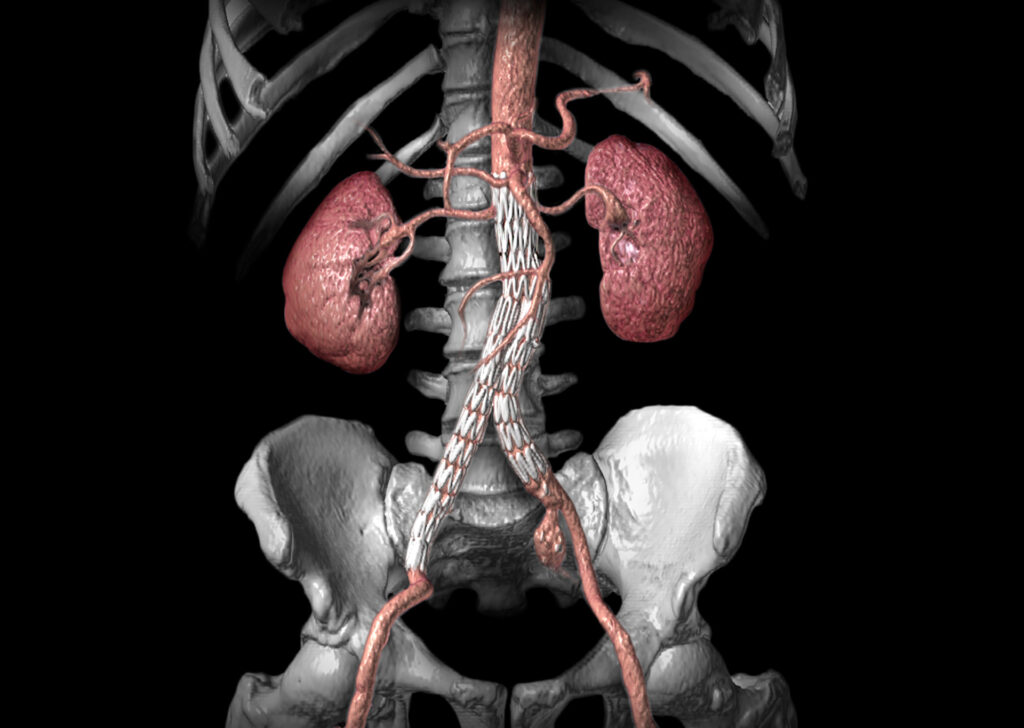 Advanced Clinical Workflows, Vascular CT EVSP.