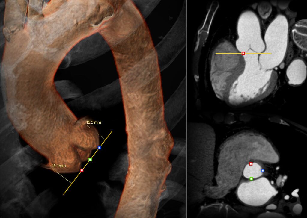 Advanced Clinical Workflows, Vascular CT TAVR.