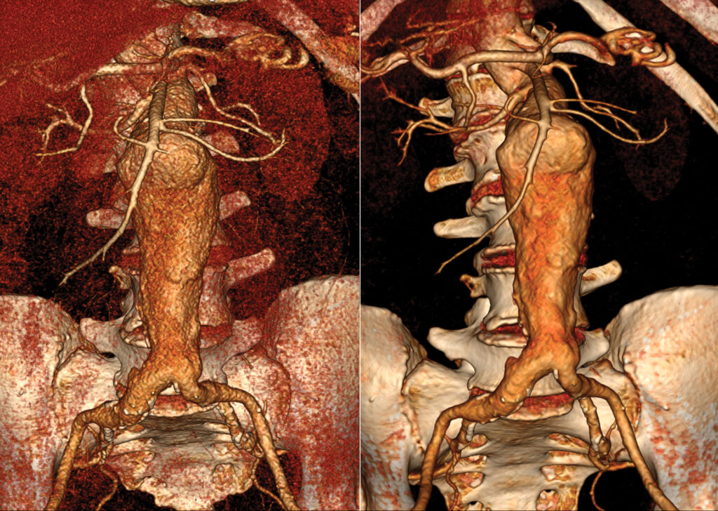 Advanced Clinical Workflows, Vascular, Vitrea Image Denoising.