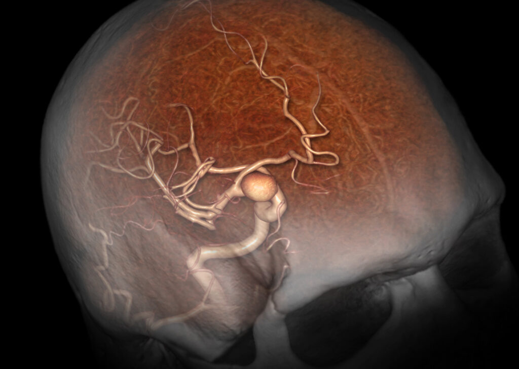 Advanced Clinical Workflows, Vascular XA 3D Angio.