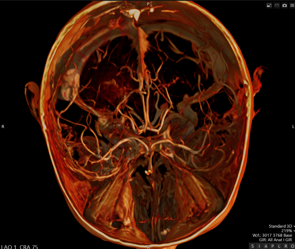 Advanced Clinical Workflows, Neuro, MR Vascular image.