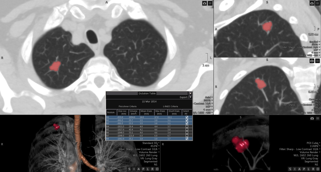 Advanced Clinical Workflows, Thoracic Lung, Visia Lung CAD