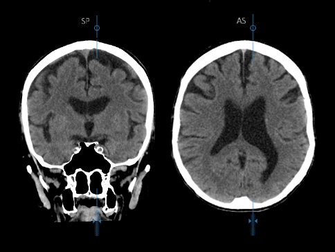 Auto MPR Brain