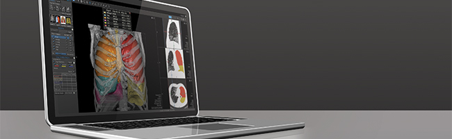 Vitrea Advanced Visualization software on a laptop.