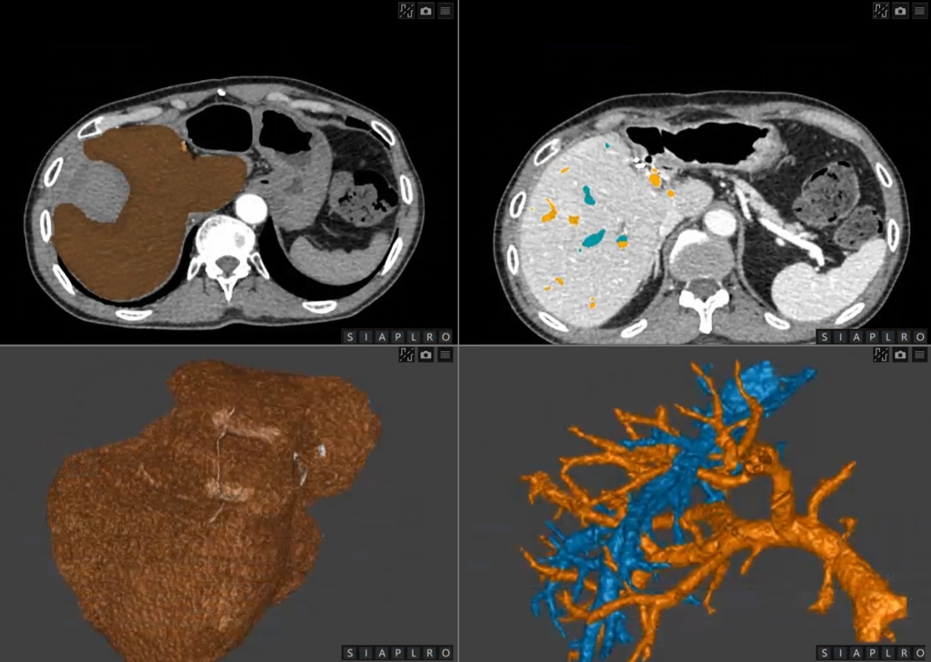 3D Volumetric Liver Segmentation Webinar